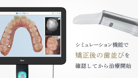 シミュレーション機能で矯正後の歯並びを確認してから治療開始