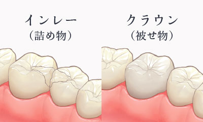 インレー（詰め物）・クラウン（被せ物）