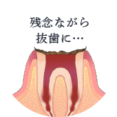 残念ながら抜歯に…