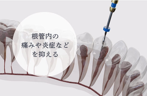 根管内の痛みや炎症などを抑える